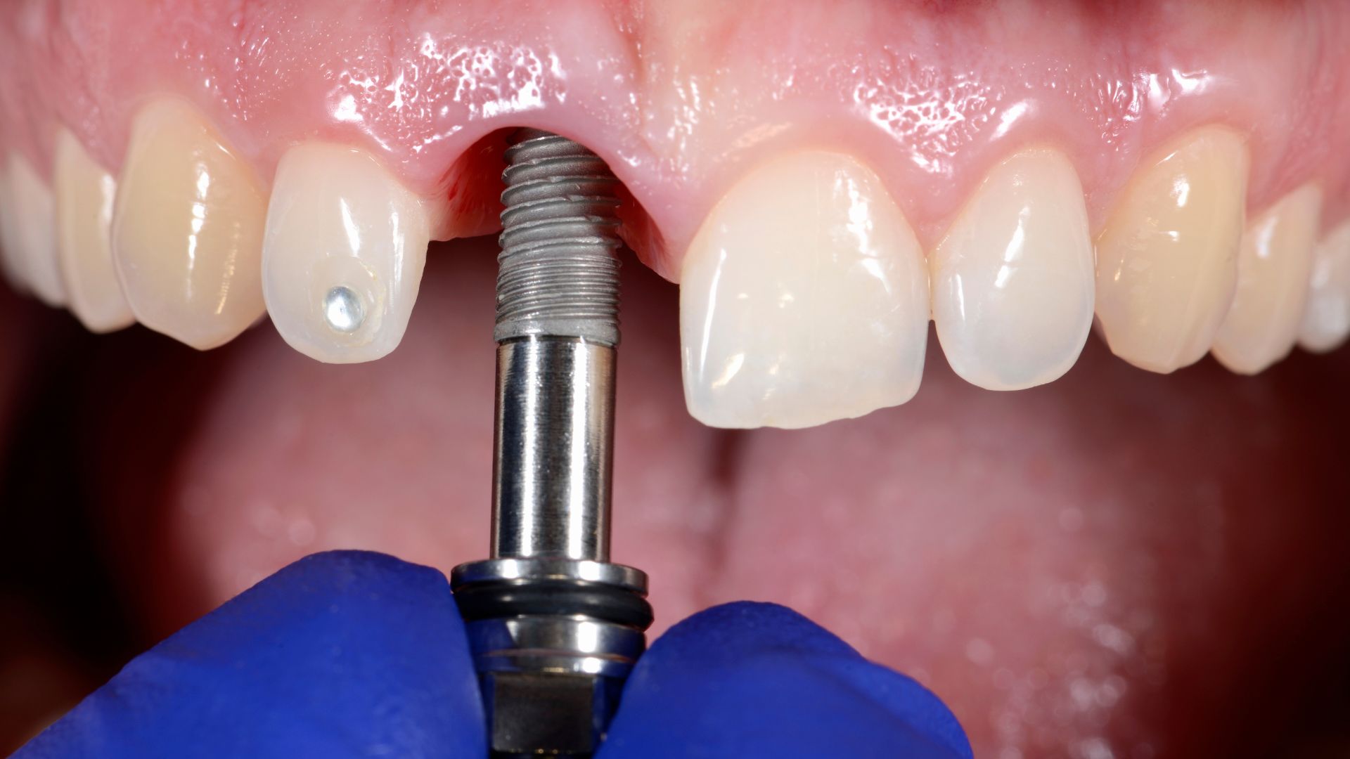 Dentalni implanti